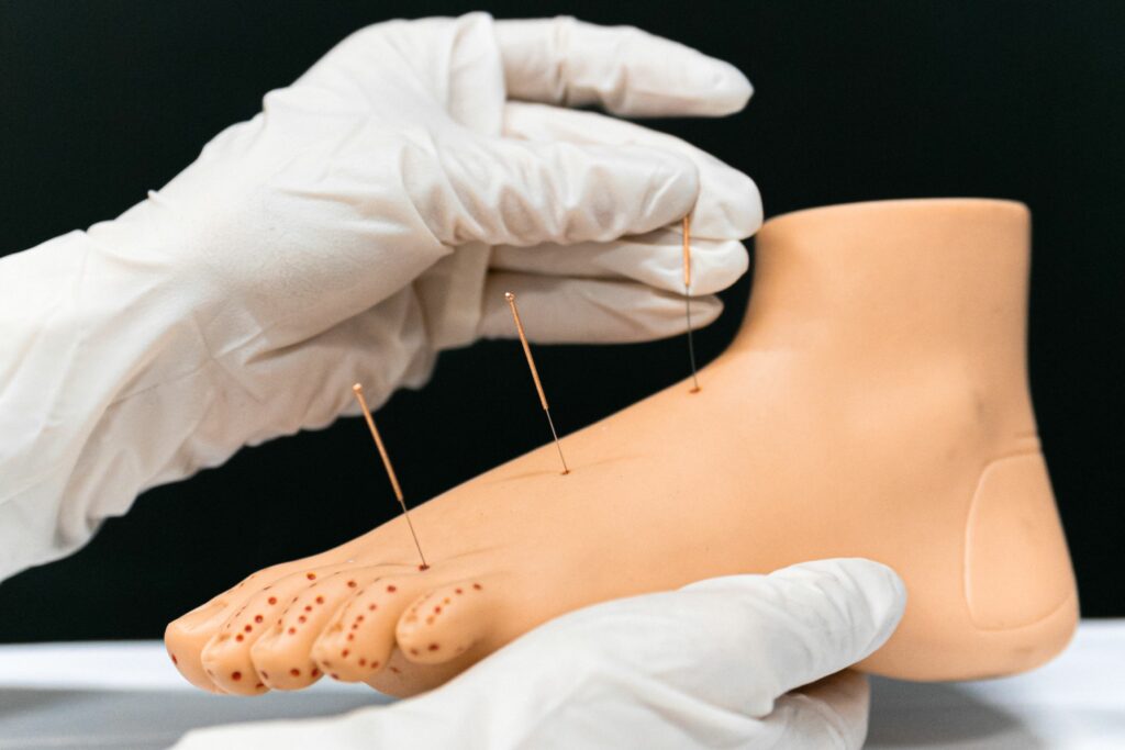 acupuncture bailleul meteren